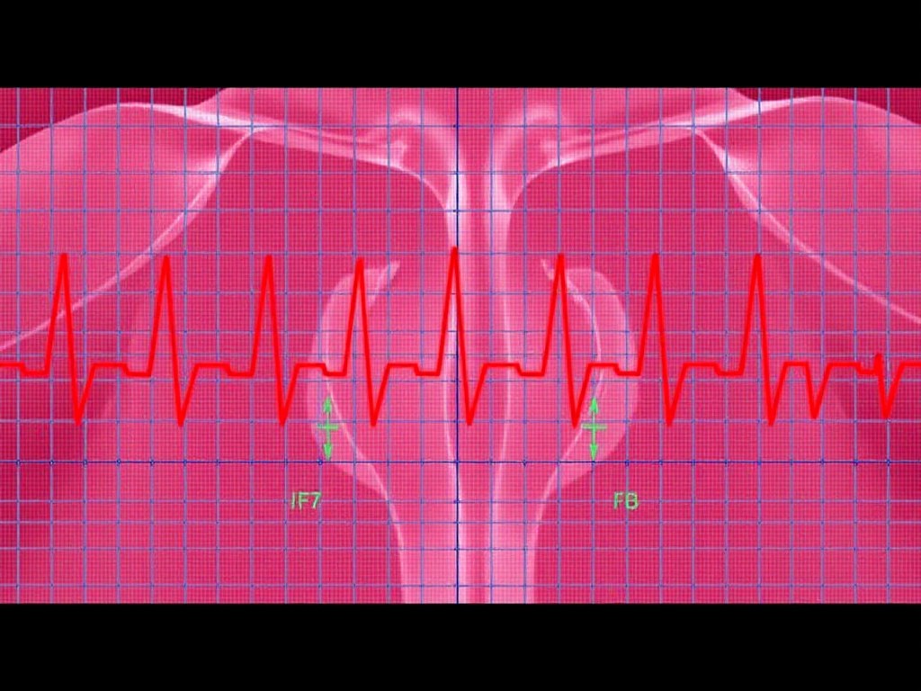 10_14_24_Evaluating-pacemaker-function-and-potential-displacement-through-electrocardiogram.jpeg