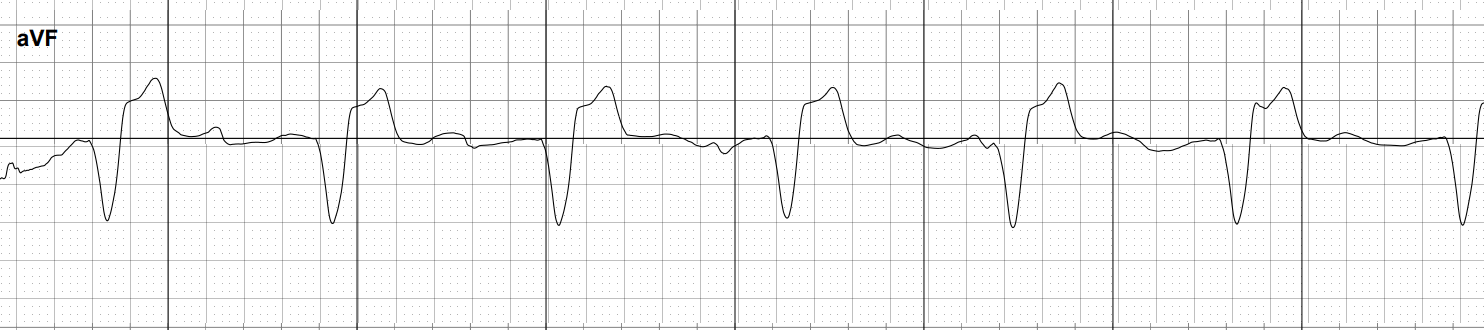 10_18_24_AI_interpretation_of_ECG_lead_aVF.png