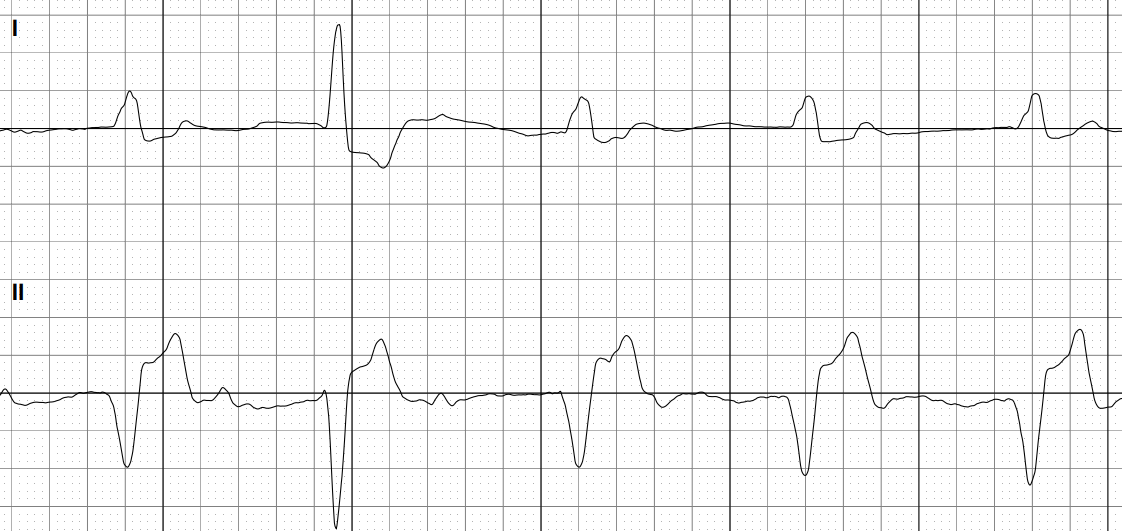 10_20_24_AI_interpretation_of_an_ECG_with_A-high-amplitude-QRS-complex-that-appears-suddenly.jpeg